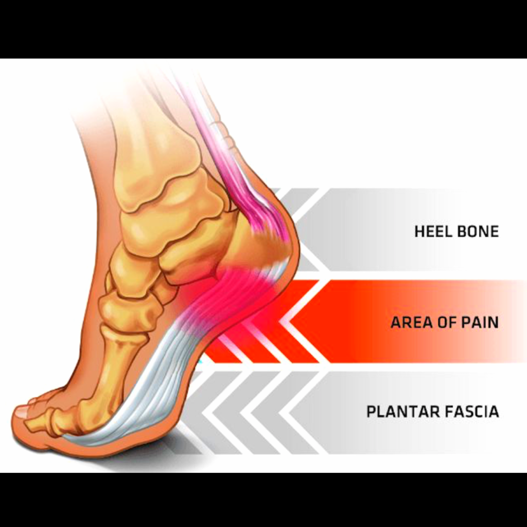 Плантарный фасциит пяточной кости. Болит пятка при нажатии